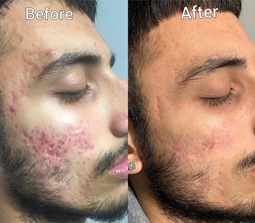 Aobenz Dark Spot Remover imported From USA ( 30 Days Guarantee)