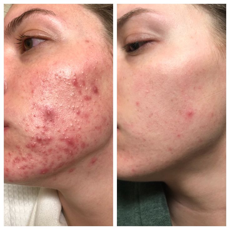 Aobenz Dark Spot Remover imported From USA ( 30 Days Guarantee)