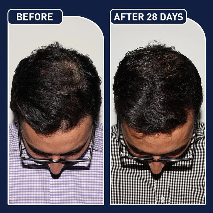 Final 3 Hours: 60%OFF🔥 FEG Plus Hair Growth Spray For Both Men & Womens