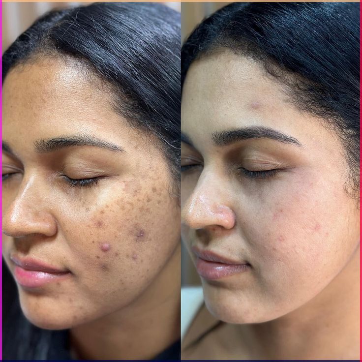 Final 3 Hours: 60%OFF🔥 Aobenz Dark Spot Remover
