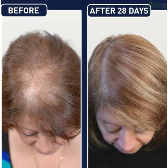 Final 3 Hours: 60%OFF🔥 FEG Plus Hair Growth Spray For Both Men & Womens