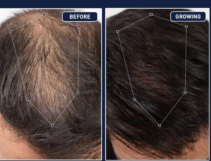 Final 3 Hours: 60%OFF🔥 FEG Plus Hair Growth Spray For Both Men & Womens