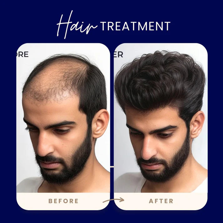 Final 3 Hours: 60%OFF🔥 FEG Plus Hair Growth Spray For Both Men & Womens